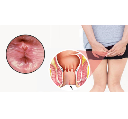 Chảy máu hoặc nứt kẽ hậu môn